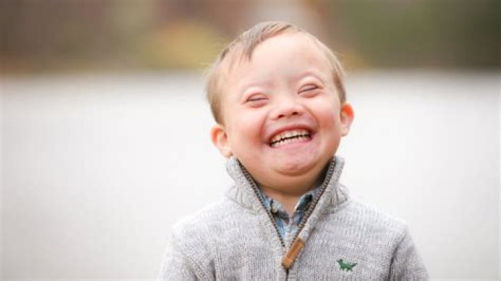 George Clooney's Twins and Down Syndrome: A Comprehensive Exploration
