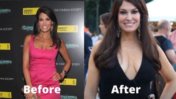 Kimberly Guilfoyle Before Plastic Surgery: A Deep Dive into Transformation and Beauty Standards