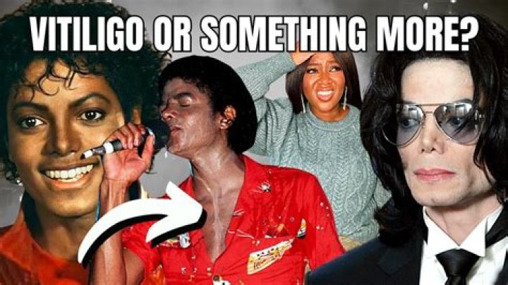 Michael Jackson's Battle with Vitiligo: Understanding the Truth Behind His Skin Condition
