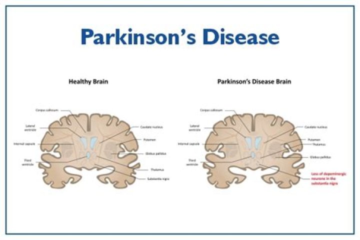 Understanding Keanu Reeves and Parkinson's Disease: A Comprehensive Insight