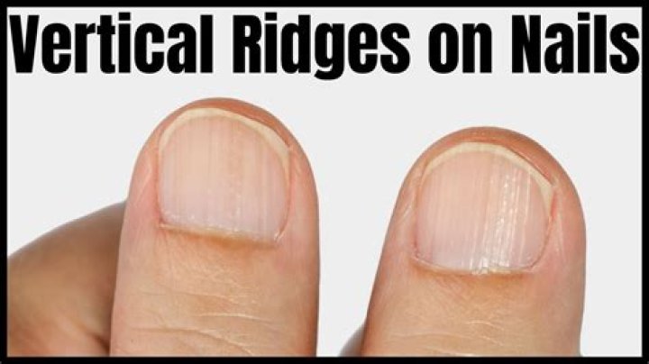 Understanding Vertical Nail Ridges and Their Connection to Vitamin Deficiencies